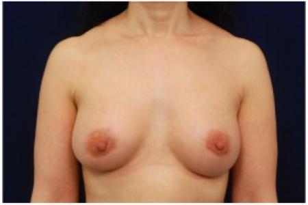 After image 1 Case #82026 - Breast Augmentation