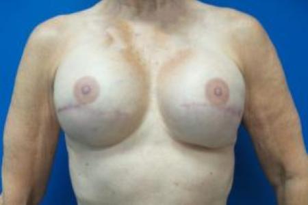 After image 1 Case #88151 - Breast Reconstruction on a 68 year old female