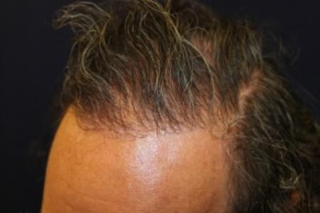 After Case #87381 - Hair Transplantation San Diego