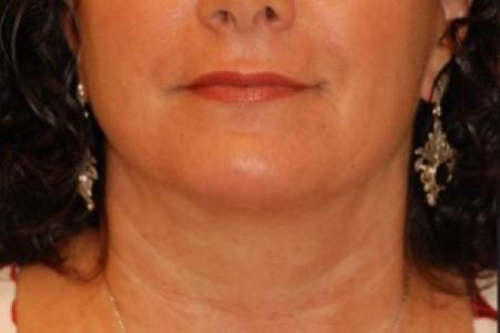 After image 1 Case #87736 - Lower Facial Rejuvenation