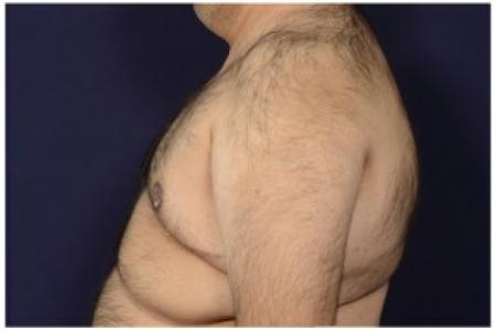 After image 3 Case #86921 - Gynecomastia