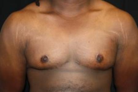 After image 1 Case #83056 - 22 year old Gynecomastia