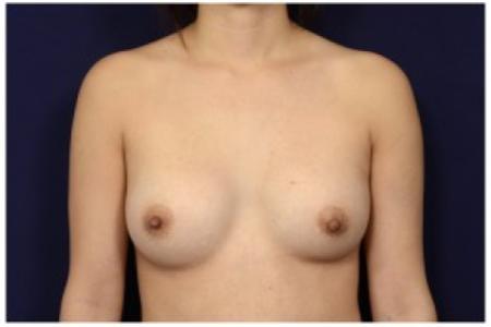 After image 1 Case #86911 - Breast Augmentation