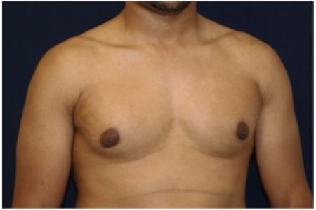 After image 2 Case #82076 - Gynecomastia