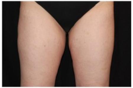 After Case #86361 - 45 yr old treated with nonsurgical fat reduction.