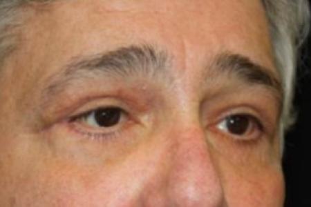 After image 2 Case #83461 - Blepharoplasty - 61 year old male.
