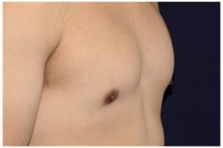 After image 4 Case #82176 - Gynecomastia