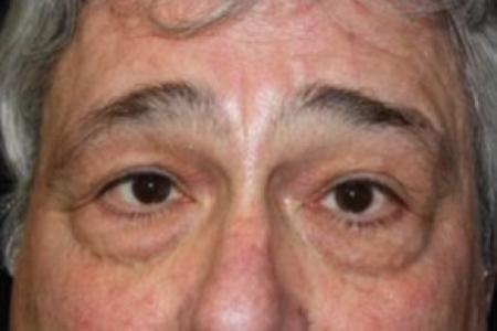 After image 1 Case #83461 - Blepharoplasty - 61 year old male.