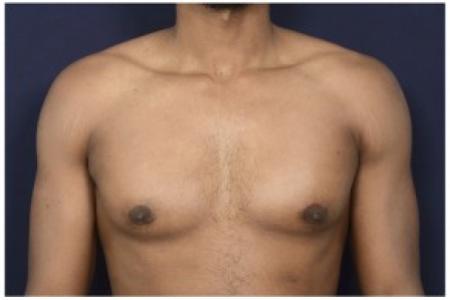 After image 1 Case #84491 - Gynecomastia