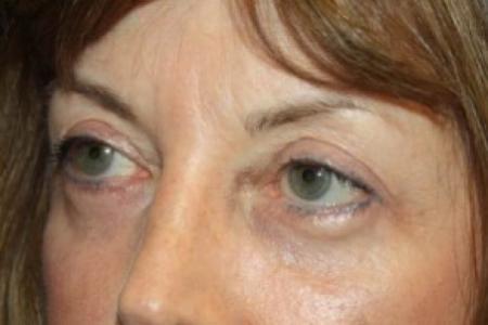 After image 2 Case #84711 - Blepharoplasty - 59 year old female.