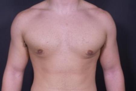 After image 1 Case #84181 - Gynecomastia