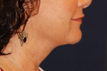 After image 3 Case #87736 - Lower Facial Rejuvenation