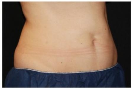 After image 2 Case #86351 - 37 year old woman treated with nonsurgical fat reduction.