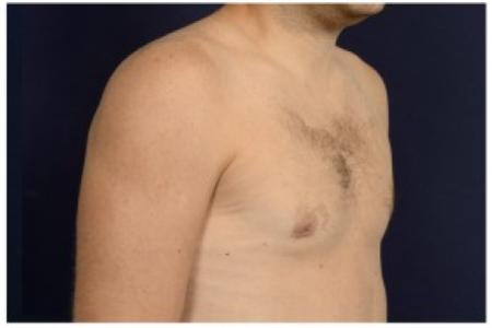 After image 2 Case #86916 - Gynecomastia