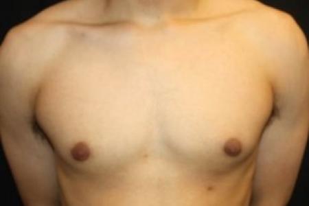 After image 1 Case #85276 - Gynecomastia - 17 year old male 