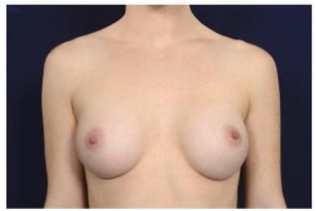 After image 1 Case #87486 - Breast Augmentation