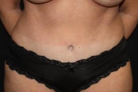 After image 1 Case #84831 - Abdominplasty - 43 year old female.