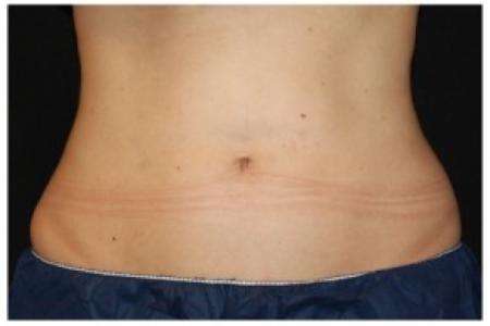 After image 1 Case #86351 - 37 year old woman treated with nonsurgical fat reduction.