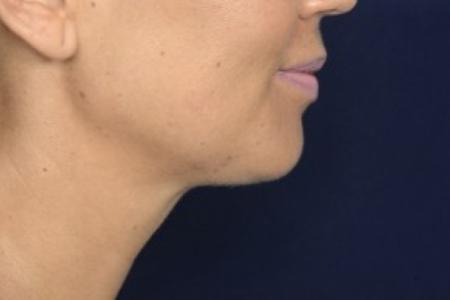 After image 3 Case #87586 - Lower Facial Rejuvenation 