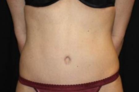 After image 1 Case #83726 - Abdominoplasty - 37 year old female.