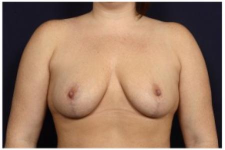 After image 1 Case #84771 - Bilateral Breast Reduction