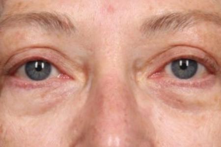 After image 1 Case #86771 - Upper Blepharoplasty ( Eyelid Lift )