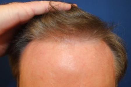 After Case #87386 - Hair Transplantation San Diego