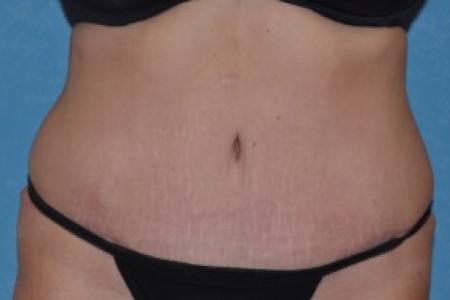 After image 1 Case #83421 - Abdominoplasty