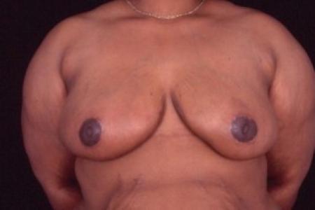 After image 1 Case #81461 - Breast Reduction/Lift