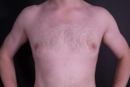 After image 1 Case #85311 - Liposuction Gynecomastia