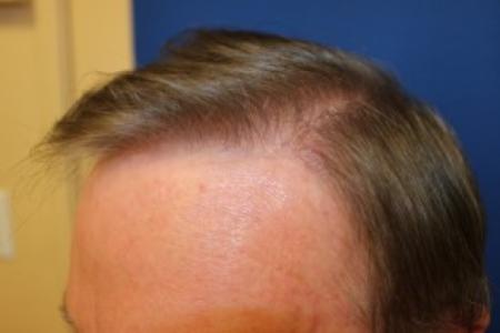 After Case #87386 - Hair Transplantation San Diego