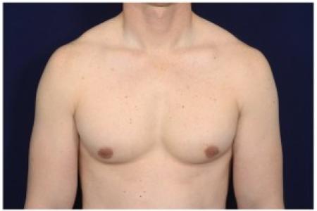 After image 1 Case #85596 - Gynecomastia