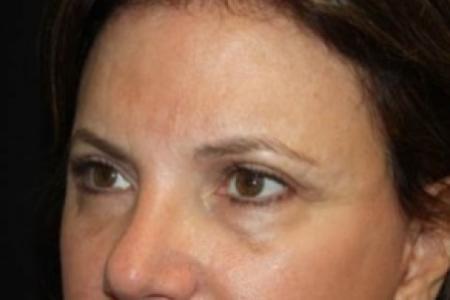 After image 2 Case #84271 - Brow Lift- 60 year old female