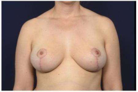 After image 1 Case #84611 - 35-44 year old woman treated with Breast Reduction