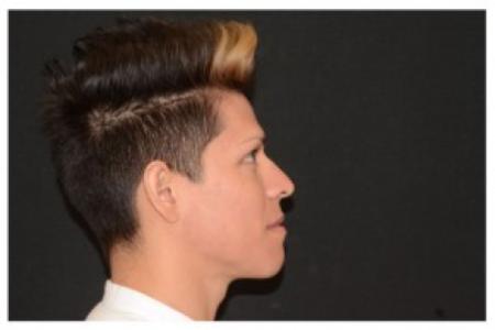After image 3 Case #87106 - Non-Surgical Rhinoplasty