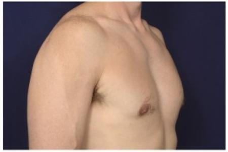 After image 2 Case #86206 - 42 year old man treated with Male Breast Reduction