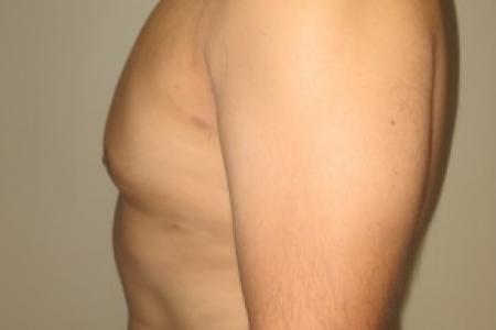 After image 3 Case #82406 - 37 Male Gynecomastia
