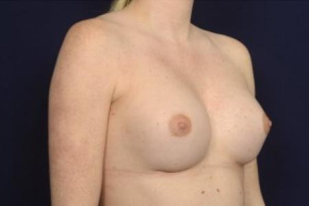 After image 2 Case #87456 - Breast Augmentation