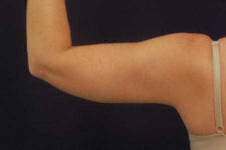 After image 2 Case #87751 - Upper Arm Liposuction