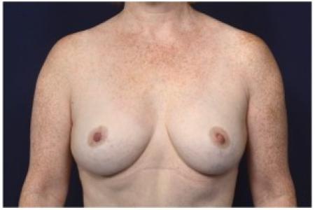 After image 1 Case #86281 - 49 year old woman treated with a Breast Lift