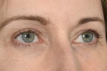 After image 3 Case #87621 - Eye Area Rejuvenation