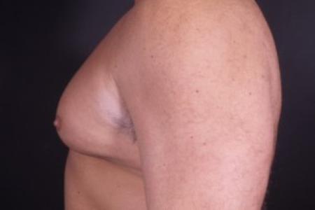 After image 2 Case #85246 - Bilateral Nipple Reduction