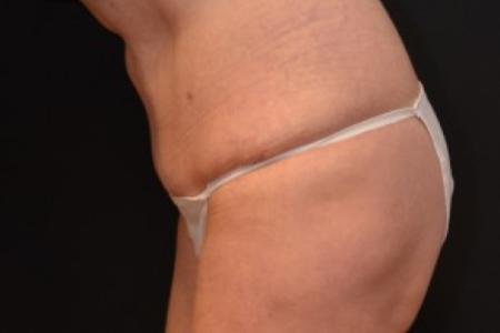 After image 2 Case #81721 - Tummy Tuck