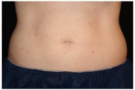 After Case #86356 - 40 yr old treated with nonsurgical fat reduction.