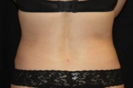 After image 1 Case #85226 - Liposuction to Flanks - 41 year old female