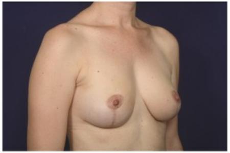After image 2 Case #84616 - 35-44 year old woman treated with Breast Reduction
