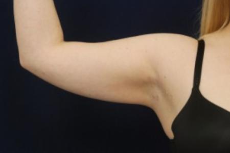 After image 2 Case #87721 - Upper Arm Liposuction