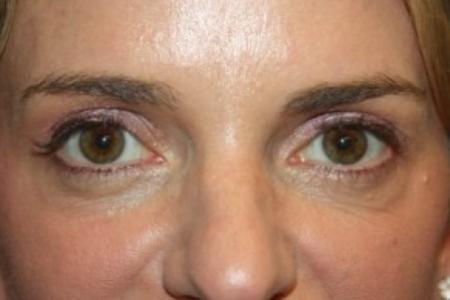 After image 1 Case #84206 - Upper Lid Blepharoplasty - 42 year old female