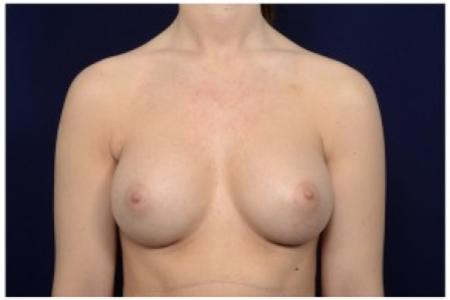 After image 1 Case #86226 - 24 year old woman treated with Breast Augmentation