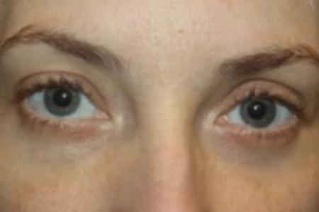 After image 1 Case #85876 - Blepharoplasty - Lower Lids Only - 34 year old female